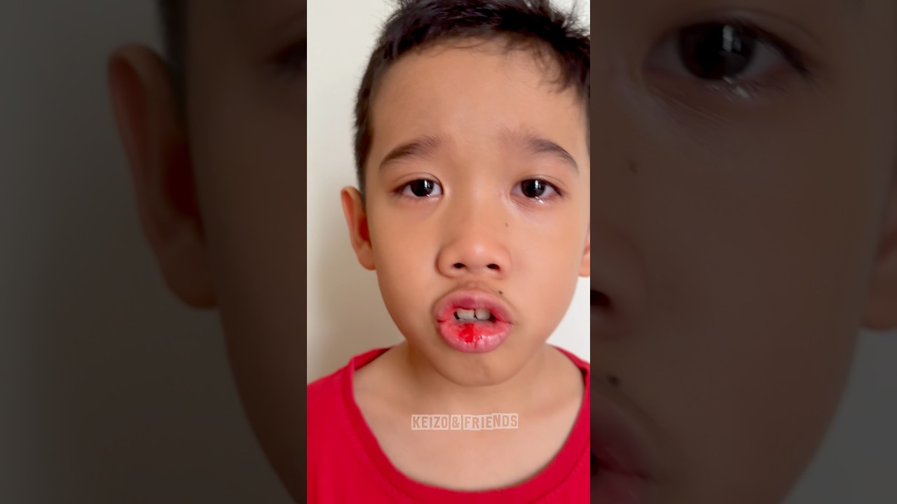 Hah bibir Keizo bengkak gede banget habis ketabrak tiang⁉️