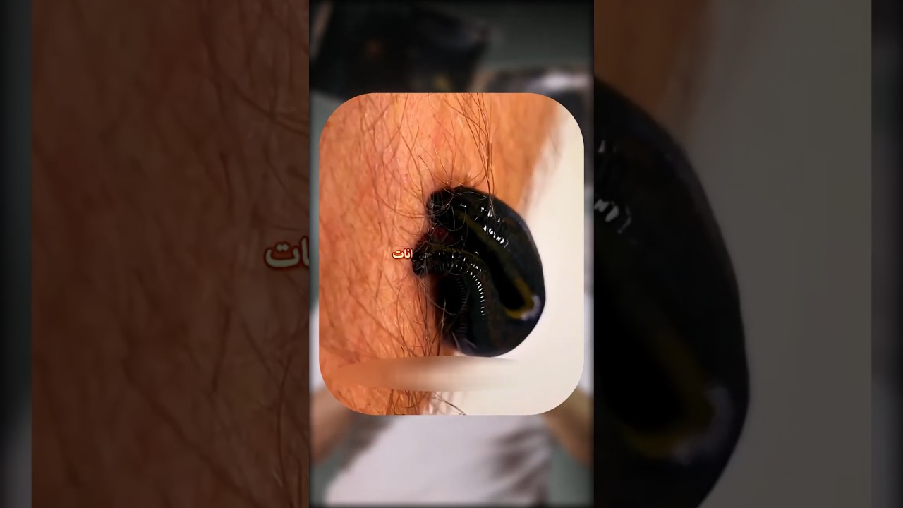 لو شفت الدودة دي اوعى تشدها! 😳🪱