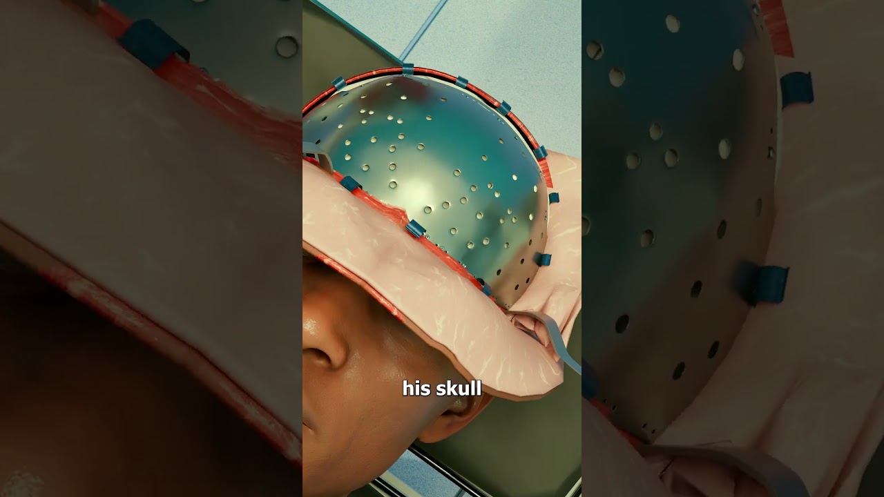 The Metal Plate That Saved His Life 😮 - Published by Zack D. Films