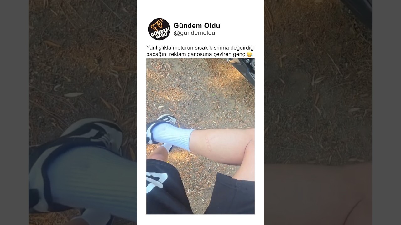 Yanlışlıkla motorun sıcak kısmına değdirdiği bacağını reklam panosuna çeviren genç 😂