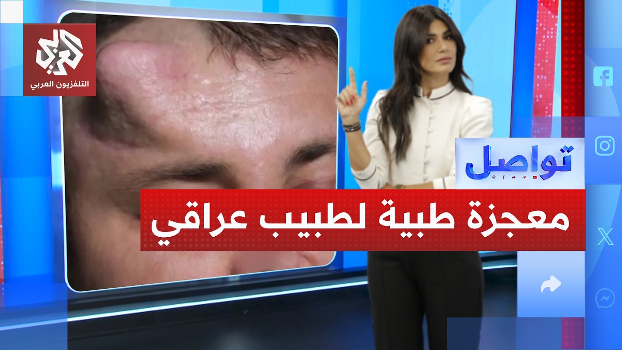 طبيب عراقي ينجح في زراعة أنف في رأس بشري.. ما القصة؟│ تواصل