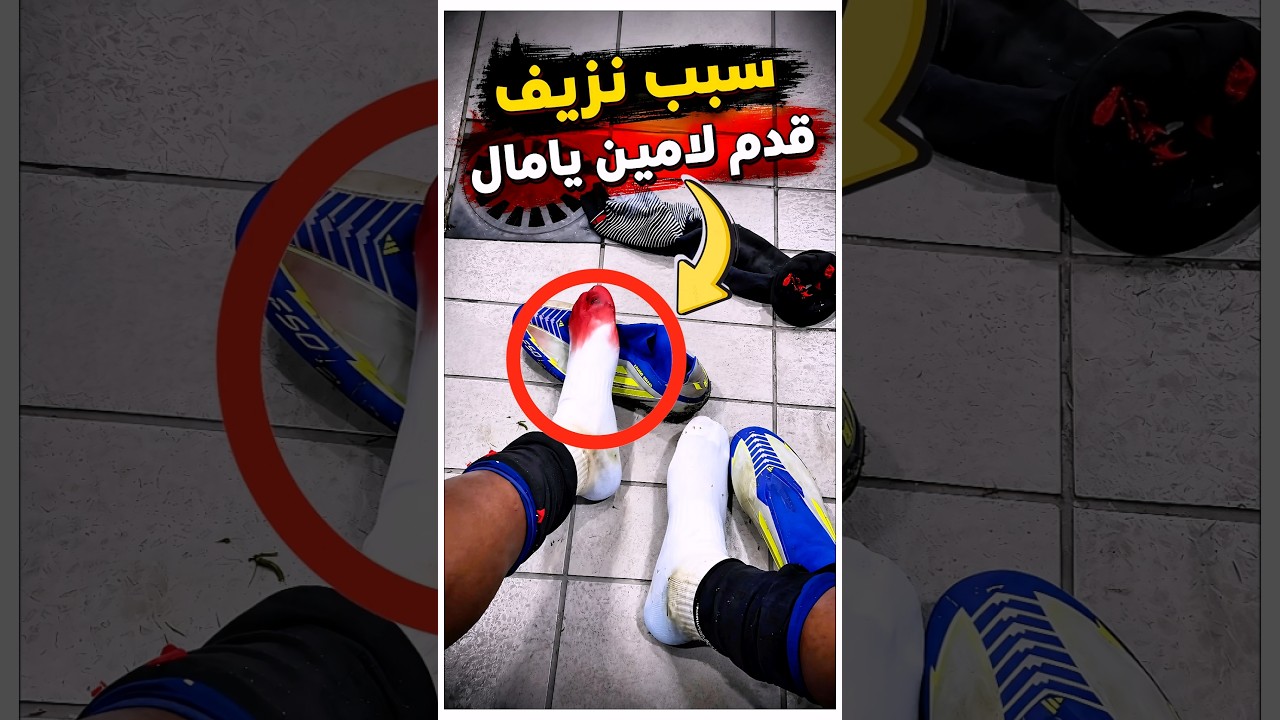 السبب المرعب وراء نزيف قدم لامين يامال 😳🩸