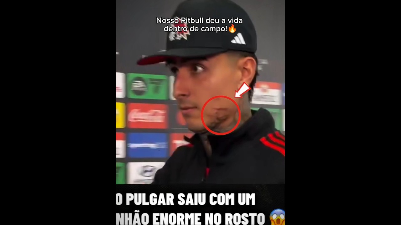 Como ficou o rosto do Pulgar depois da guerra contra o Cruzeiro.🔥☠️ #flamengo #libertadores #pulgar