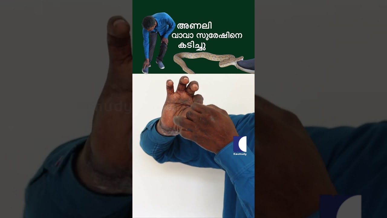 അണലി വാവാ സുരേഷിനെ കടിച്ചു #russelsviper #snakebite #vavasuresh
